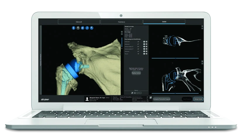 Blueprint computer planning screen showing a three-dimensional shoulder model with a planned implant and cross-sectional views