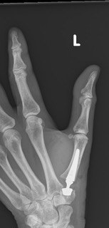 Post-operative X-ray of the hand showing the TOUCH prosthesis at the thumb base