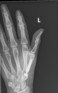 Second post-operative view of the TOUCH thumb base joint replacement