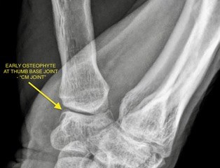 X-ray showing an early osteophyte at the thumb carpometacarpal joint