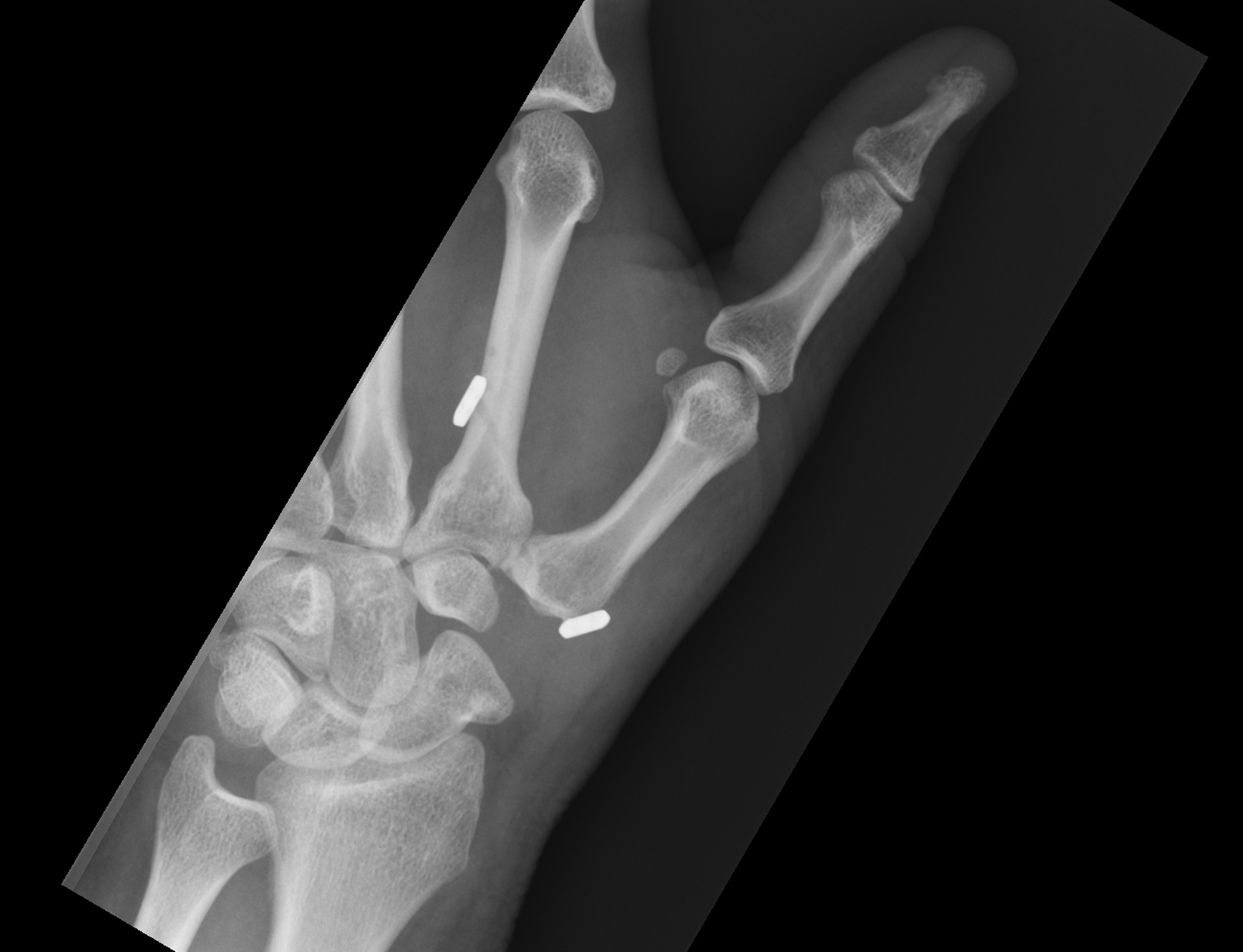 Postoperative thumb radiograph illustrating trapeziectomy and two Mini TightRope fixation buttons at the thumb and index-finger metacarpals