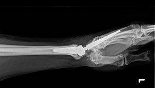 Post-operative lateral radiograph showing the Motec wrist prosthesis