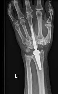 Post-operative PA radiograph showing the Motec wrist prosthesis