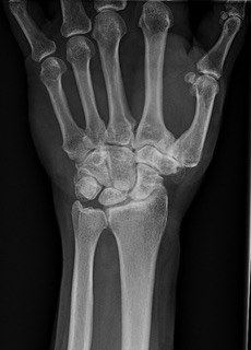 Pre-operative PA radiograph of an arthritic wrist
