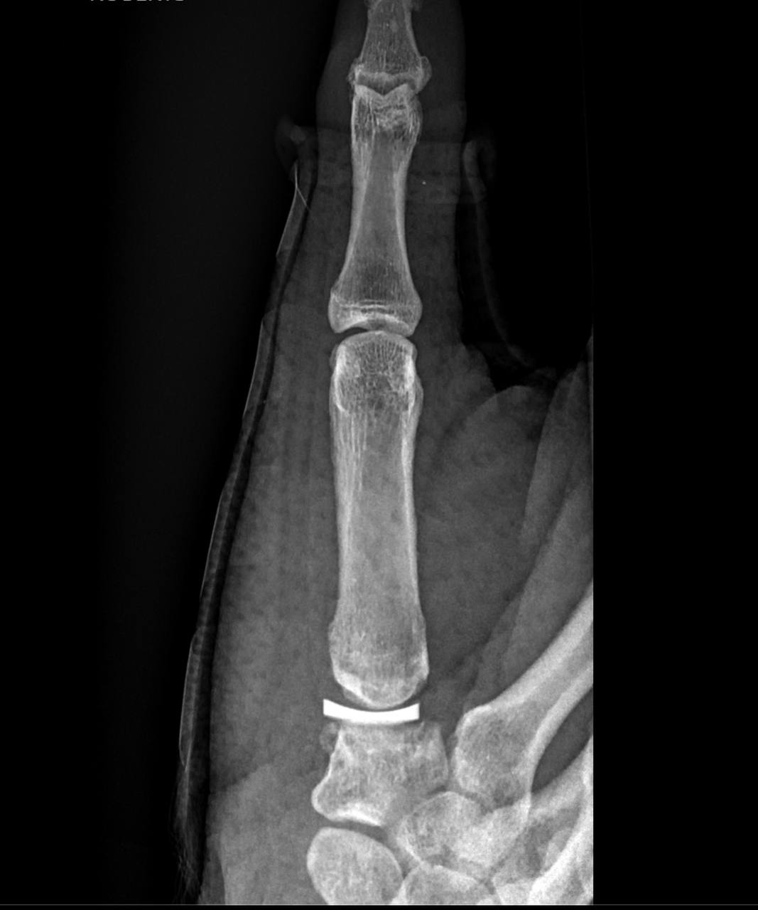 Thumb X-Ray